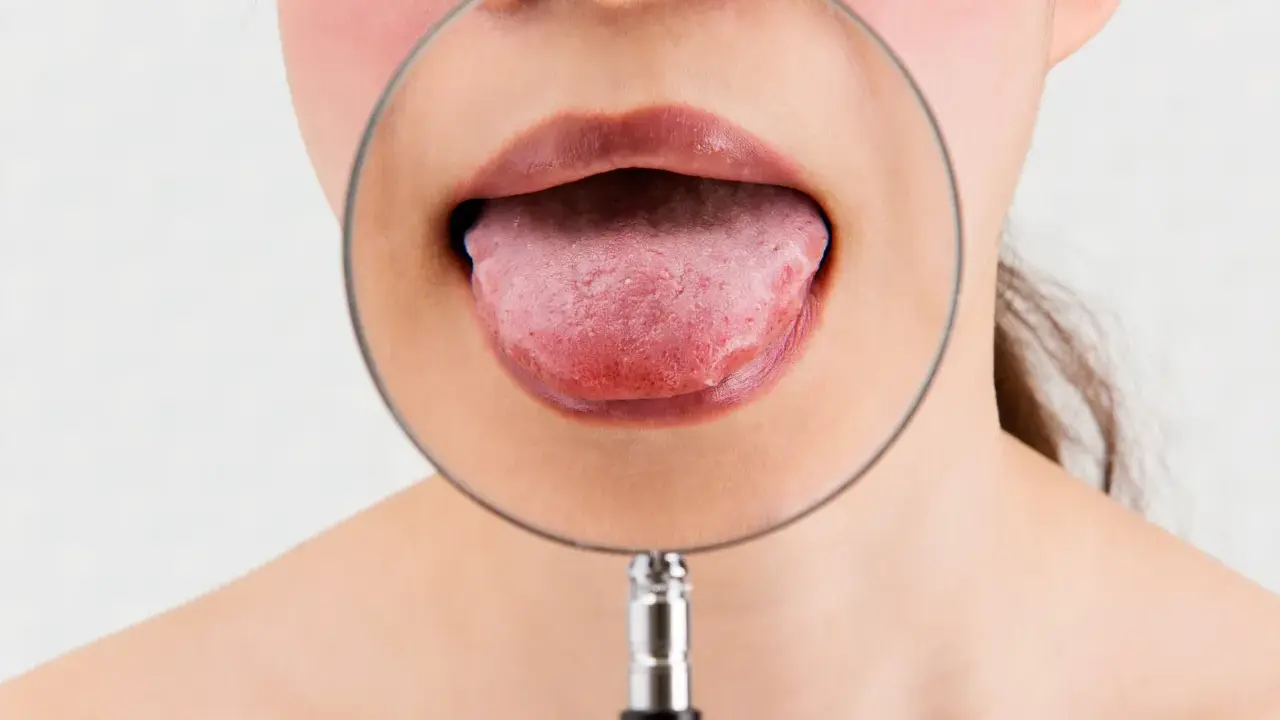 Język pod lupą. Szukasz zamiennika Solcoseryl na afty?