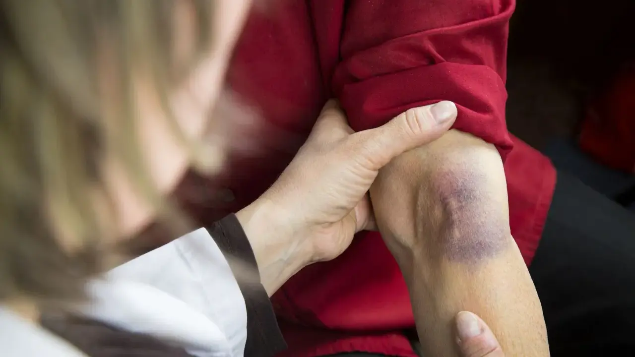 Dłoń bada siniak na ramieniu, który może wskazywać na problemy z krzepliwością krwi.