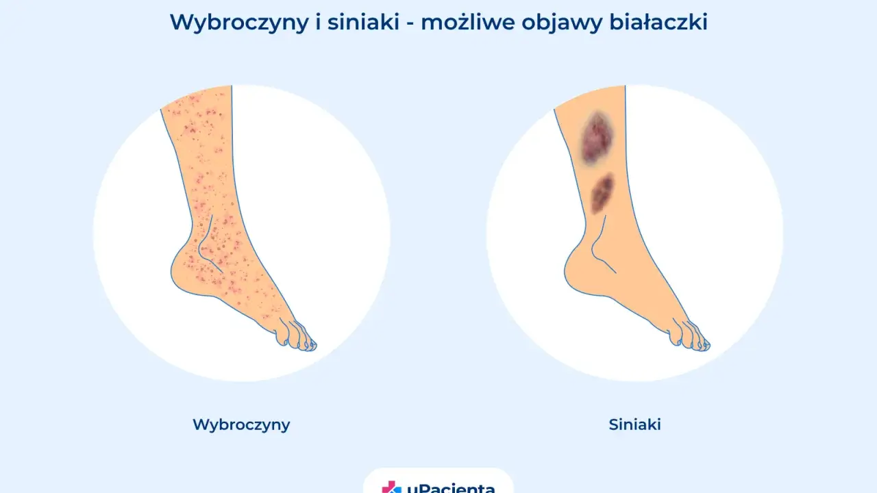 Wybroczyny i siniaki na nogach mogą być objawami białaczki. Czy z białaczką można żyć? Tak, dzięki nowoczesnemu leczeniu.