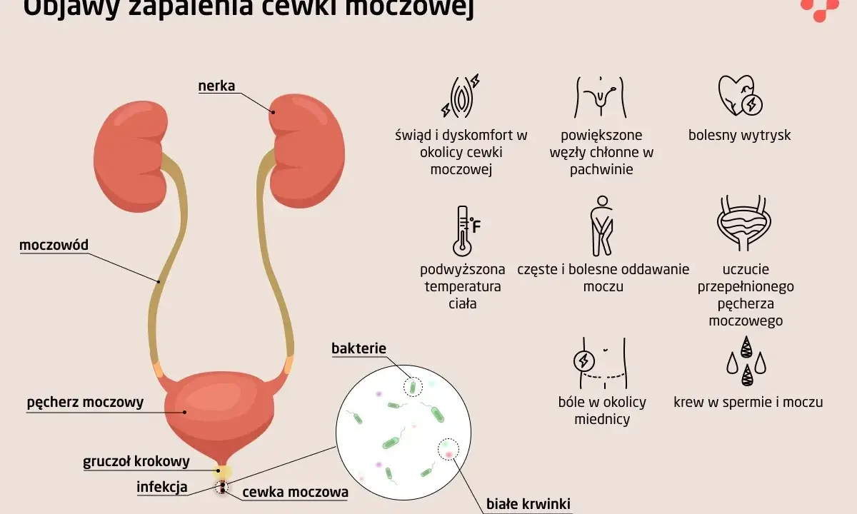Objawy zapalenia cewki moczowej (ICD-10): pieczenie, ból, gorączka, krew w moczu, powiększone węzły chłonne.