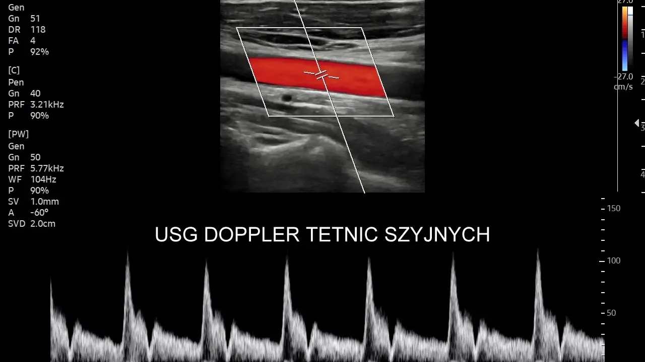 USG doppler tętnic szyjnych pokazuje przepływ krwi. Analiza wykresu dopplerowskiego może pomóc w ocenie objawów chorób naczyniowych.