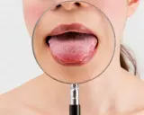 Język pod lupą. Szukasz zamiennika Solcoseryl na afty?