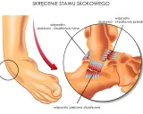 Ilustracja przedstawia skręcenie stawu skokowego, często klasyfikowane jako uraz stawu skokowego ICD10. Widoczne są uszkodzone więzadła.