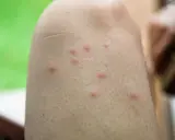Kilka czerwonych, swędzących bąbli na skórze, sugerujących ugryzienie przez owada (ICD-10).