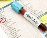 Próbówka z krwią do testu witaminy B12 leży na karcie wyników badań. Czerwone kółko zaznacza pozycję "B12", sugerując diagnostykę niedoboru B12 ICD 10.