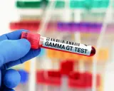 Ręka w niebieskiej rękawiczce trzyma probówkę z napisem "GAMMA GT TEST". Wynik badania wskazuje na ggtp norma.
