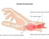 Ilustracja pokazuje chorobę De Quervaina, zapalenie ścięgien kciuka (EPB i APL) oraz pochewek ścięgnistych.