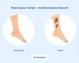 Wybroczyny i siniaki na nogach mogą być objawami białaczki. Czy z białaczką można żyć? Tak, dzięki nowoczesnemu leczeniu.
