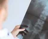 Lekarz analizuje RTG kręgosłupa. Czy RTG kręgosłupa wykryje raka? Badanie obrazowe może pomóc w diagnostyce.