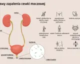 Objawy zapalenia cewki moczowej (ICD-10): pieczenie, ból, gorączka, krew w moczu, powiększone węzły chłonne.