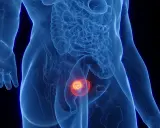 Anatomical rendering showing a glowing tumor within the bladder, indicative of a guz pęcherza moczowego icd 10.