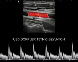 USG doppler tętnic szyjnych pokazuje przepływ krwi. Analiza wykresu dopplerowskiego może pomóc w ocenie objawów chorób naczyniowych.