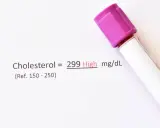 Wynik cholesterolu 299 mg/dL, co jest wysokim wynikiem. Czy ezoleta to statyna, która pomoże obniżyć ten poziom?