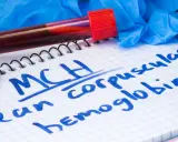 Notatnik z zapisanym "MCH mean corpuscular hemoglobin", probówki z krwią, rękawiczki i stetoskop. MCH podwyższone może wskazywać na pewne schorzenia.