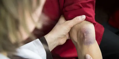 Dłoń bada siniak na ramieniu, który może wskazywać na problemy z krzepliwością krwi.