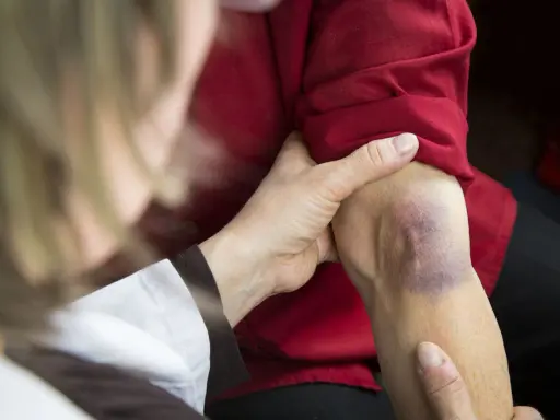 Dłoń bada siniak na ramieniu, który może wskazywać na problemy z krzepliwością krwi.