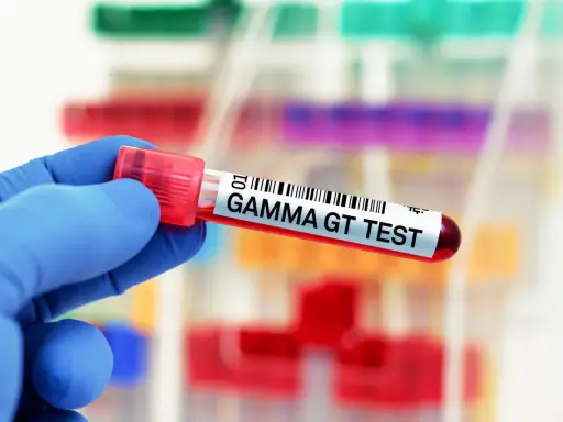Ręka w niebieskiej rękawiczce trzyma probówkę z napisem "GAMMA GT TEST". Wynik badania wskazuje na ggtp norma.