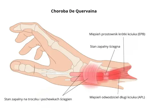 Ilustracja pokazuje chorobę De Quervaina, zapalenie ścięgien kciuka (EPB i APL) oraz pochewek ścięgnistych.