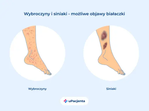 Wybroczyny i siniaki na nogach mogą być objawami białaczki. Czy z białaczką można żyć? Tak, dzięki nowoczesnemu leczeniu.