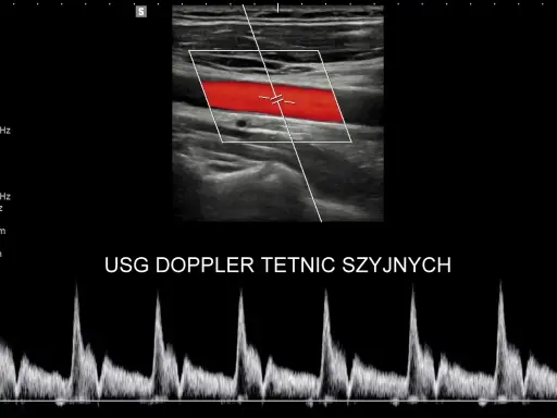 USG doppler tętnic szyjnych pokazuje przepływ krwi. Analiza wykresu dopplerowskiego może pomóc w ocenie objawów chorób naczyniowych.