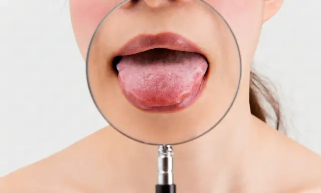 Język pod lupą. Szukasz zamiennika Solcoseryl na afty?
