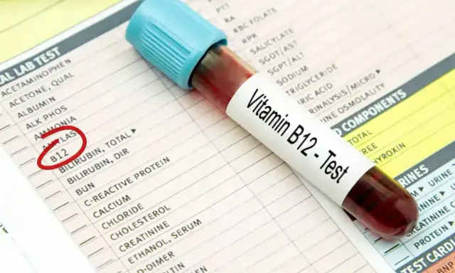 Próbówka z krwią do testu witaminy B12 leży na karcie wyników badań. Czerwone kółko zaznacza pozycję "B12", sugerując diagnostykę niedoboru B12 ICD 10.
