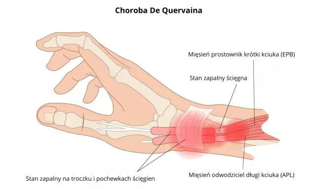 Ilustracja pokazuje chorobę De Quervaina, zapalenie ścięgien kciuka (EPB i APL) oraz pochewek ścięgnistych.