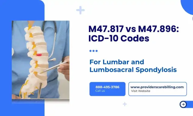 Model kręgosłupa z zaznaczonymi zmianami zwyrodnieniowymi. Mowa o kodach ICD-10 M47.817 i M47.896 dla spondylozy lędźwiowej.