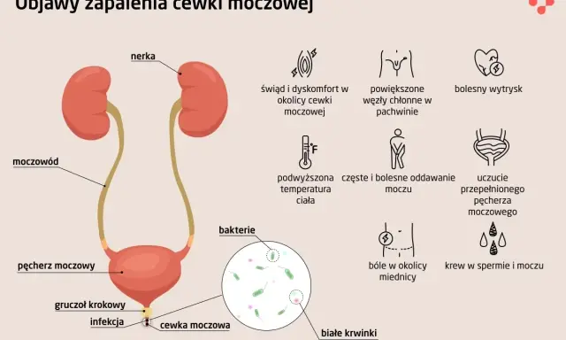 Objawy zapalenia cewki moczowej (ICD-10): pieczenie, ból, gorączka, krew w moczu, powiększone węzły chłonne.