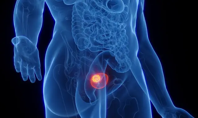 Anatomical rendering showing a glowing tumor within the bladder, indicative of a guz pęcherza moczowego icd 10.