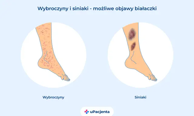 Wybroczyny i siniaki na nogach mogą być objawem białaczki. Po lewej wybroczyny, po prawej siniaki.
