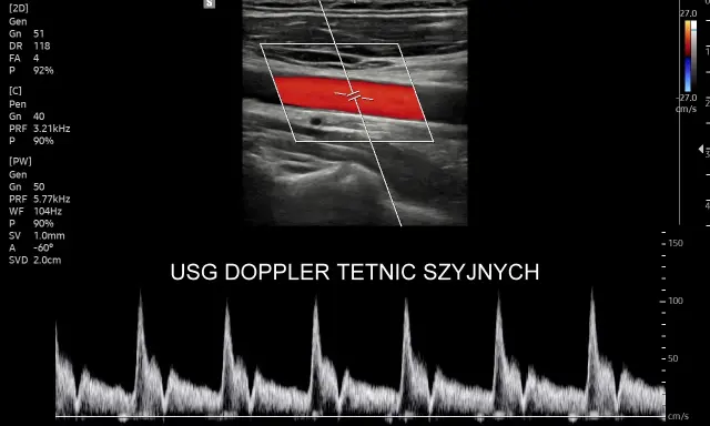 USG doppler tętnic szyjnych pokazuje przepływ krwi. Analiza wykresu dopplerowskiego może pomóc w ocenie objawów chorób naczyniowych.