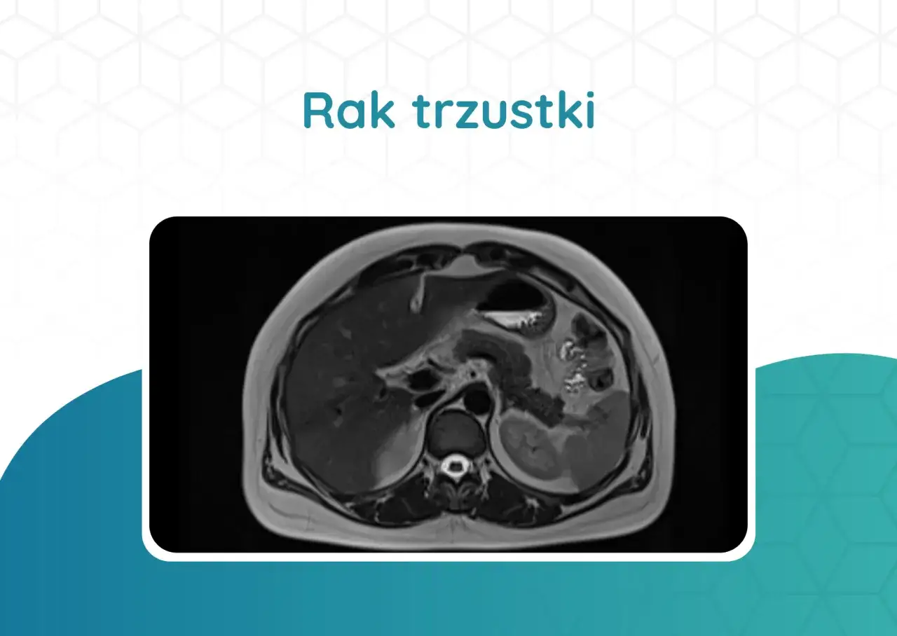 Przekrój jamy brzusznej na rezonansie magnetycznym. Czy RTG brzucha wykryje raka trzustki? Obraz pokazuje narządy wewnętrzne.