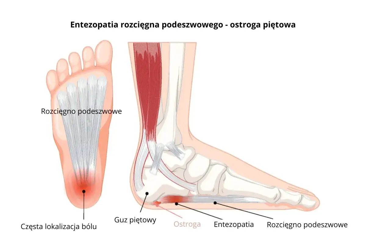 Anatomia stopy z zaznaczoną entezopatią rozcięgna podeszwowego i ostrogą piętową, kod choroby m77.