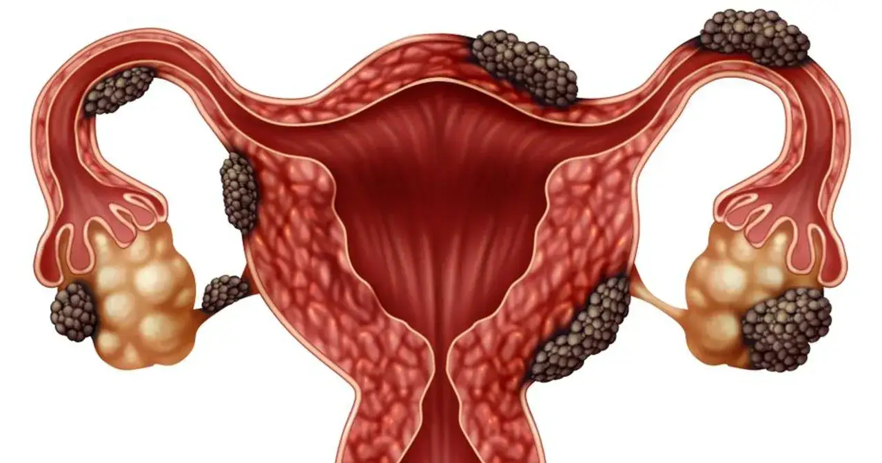 Anatomical illustration of female reproductive organs showing uterine fibroids and ovarian cysts, potentially related to n93 kod choroby.