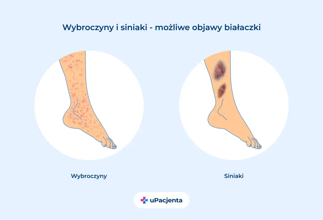 Wybroczyny i siniaki na nogach mogą być objawem zaawansowanego stadium białaczki szpikowej.