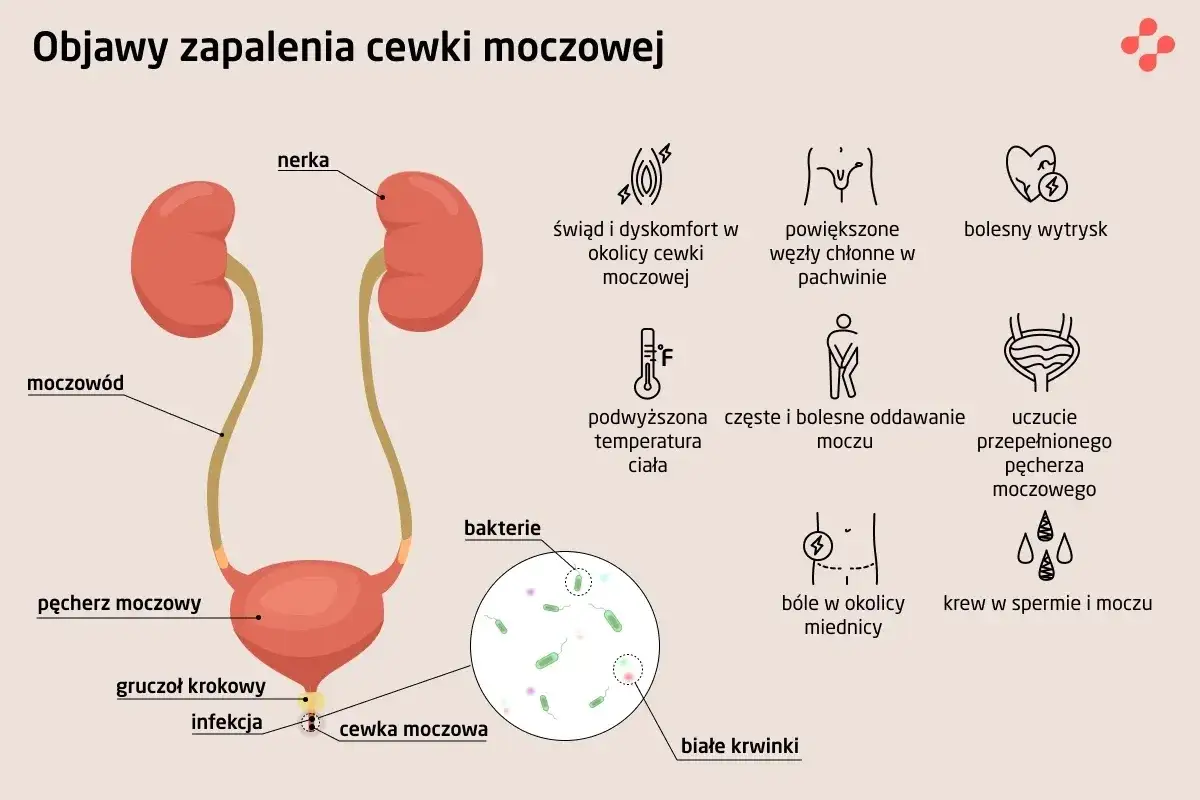 Objawy zapalenia cewki moczowej (ICD-10): pieczenie, ból, gorączka, krew w moczu, problemy z oddawaniem moczu.