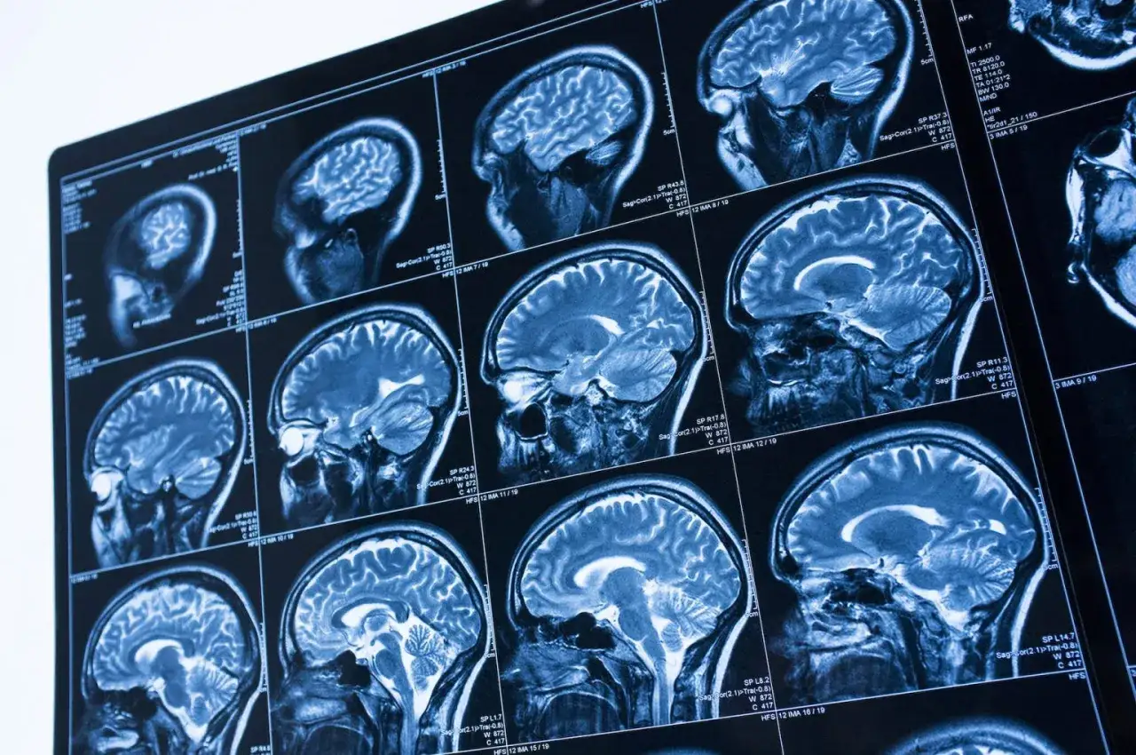 Sekwencje rezonansu magnetycznego mózgu, pokazujące przekroje. Wzmocnienie kontrastowe w rezonansie uwidacznia szczegóły.