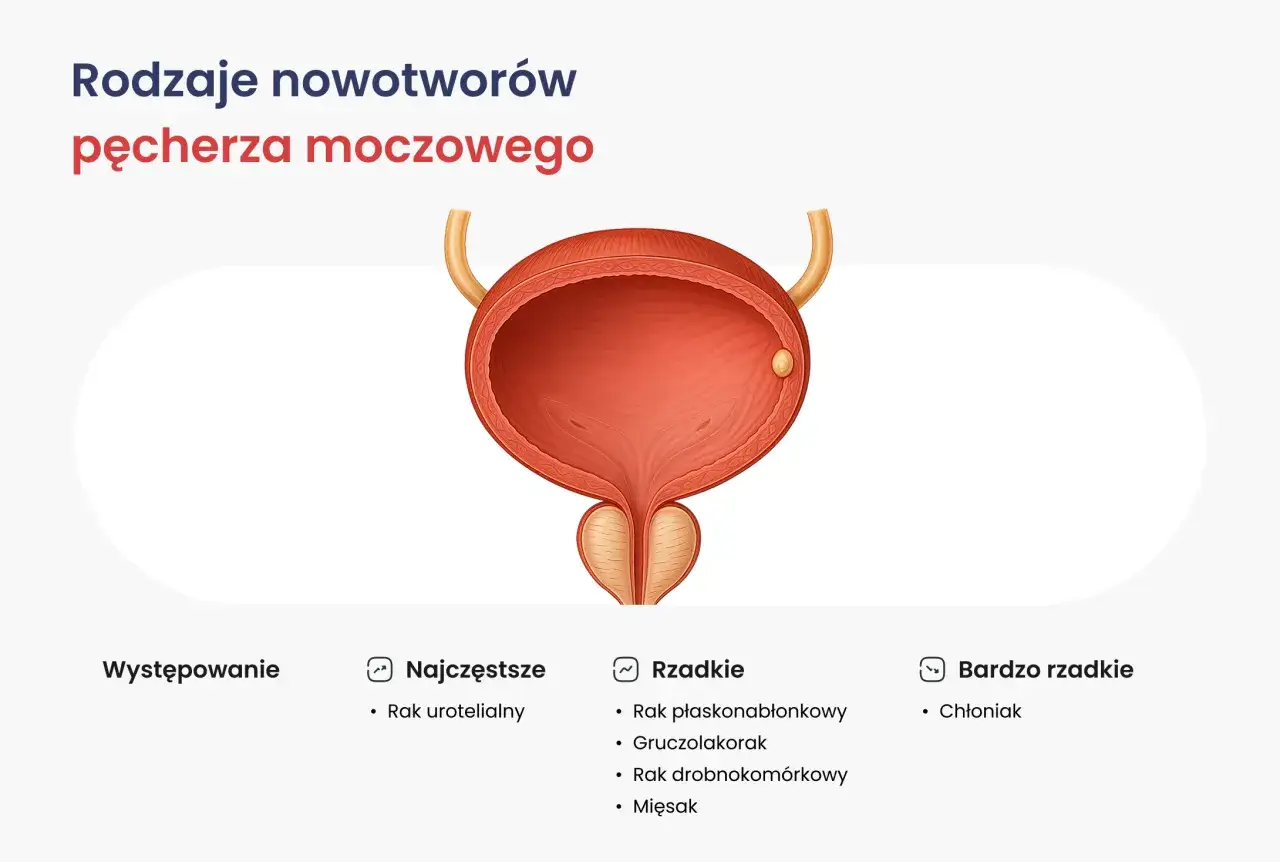 Ilustracja przedstawia pęcherz moczowy z widocznym guzem. Opisuje rodzaje nowotworów pęcherza moczowego, w tym raka urotelialnego, który jest najczęstszy.