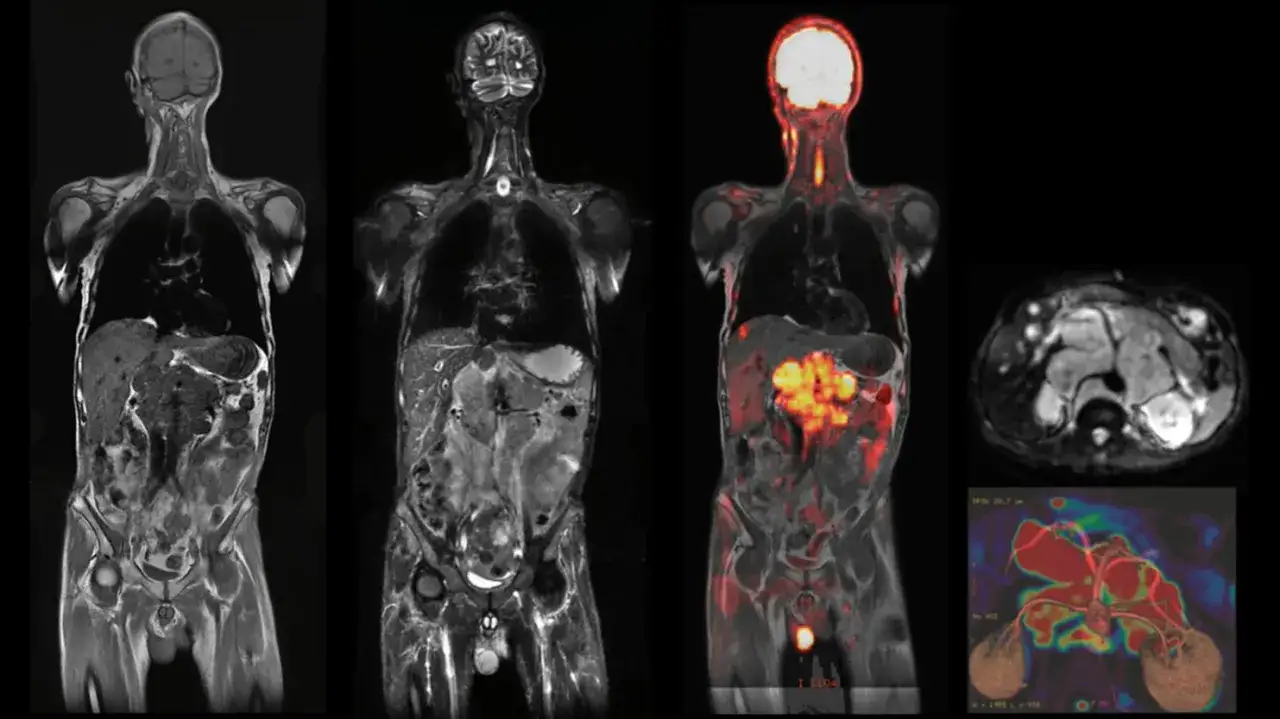 Wyniki rezonansu magnetycznego od razu: obrazy całego ciała, przekroje poprzeczne i fuzja PET-MR ukazujące szczegóły anatomiczne i metaboliczne.