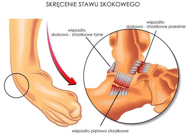Ilustracja przedstawia skręcenie stawu skokowego, często klasyfikowane jako uraz stawu skokowego ICD10. Widoczne są uszkodzone więzadła.