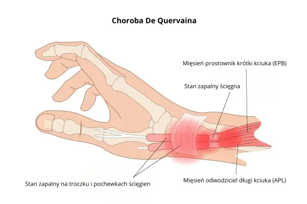 Ilustracja pokazuje chorobę De Quervaina, zapalenie ścięgien kciuka (EPB i APL) oraz pochewek ścięgnistych.