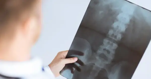Lekarz analizuje RTG kręgosłupa. Czy RTG kręgosłupa wykryje raka? Badanie obrazowe może pomóc w diagnostyce.