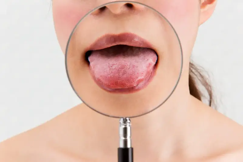 Język pod lupą. Szukasz zamiennika Solcoseryl na afty?